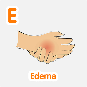 Edema