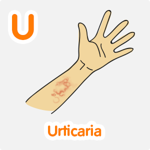 Urticaria
